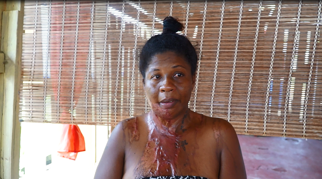Alicia Damijo with her scars from the acid attack